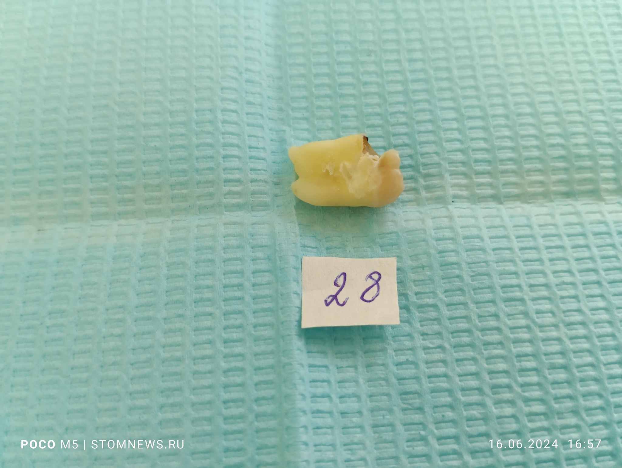 Removed 28 wisdom tooth with proximal caries - My, The medicine, Dentistry, Teeth, Opinion, Doctors, Wisdom tooth, Polyclinic, Operation, Treatment