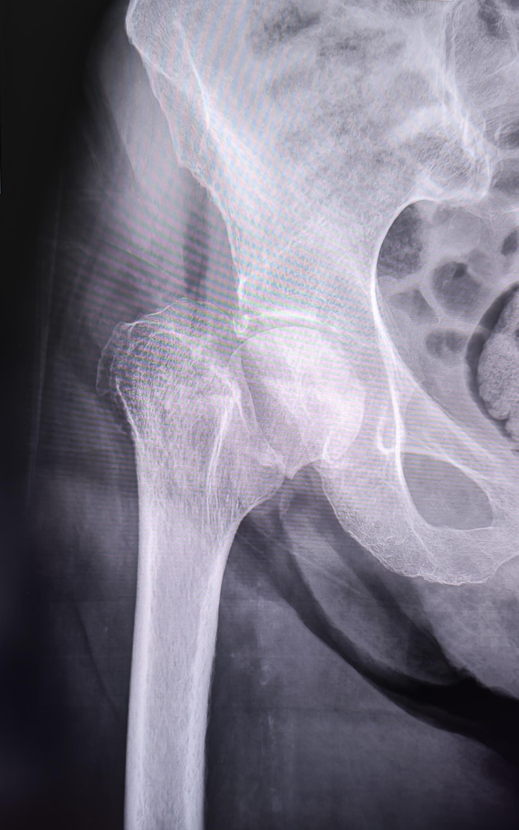 Fracture of the femoral neck - My, The medicine, Army, Military enlistment office, Fracture, Joints, X-ray, Radiology, Conscription, Longpost