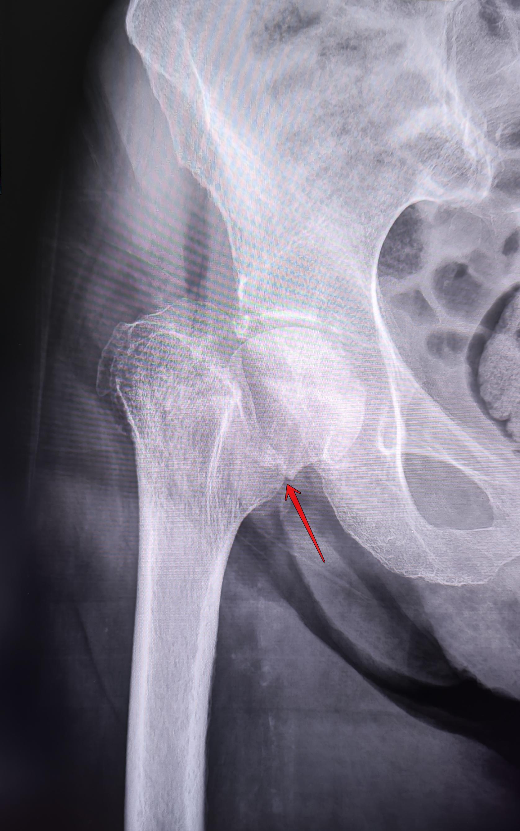 Fracture of the femoral neck - My, The medicine, Army, Military enlistment office, Fracture, Joints, X-ray, Radiology, Conscription, Longpost