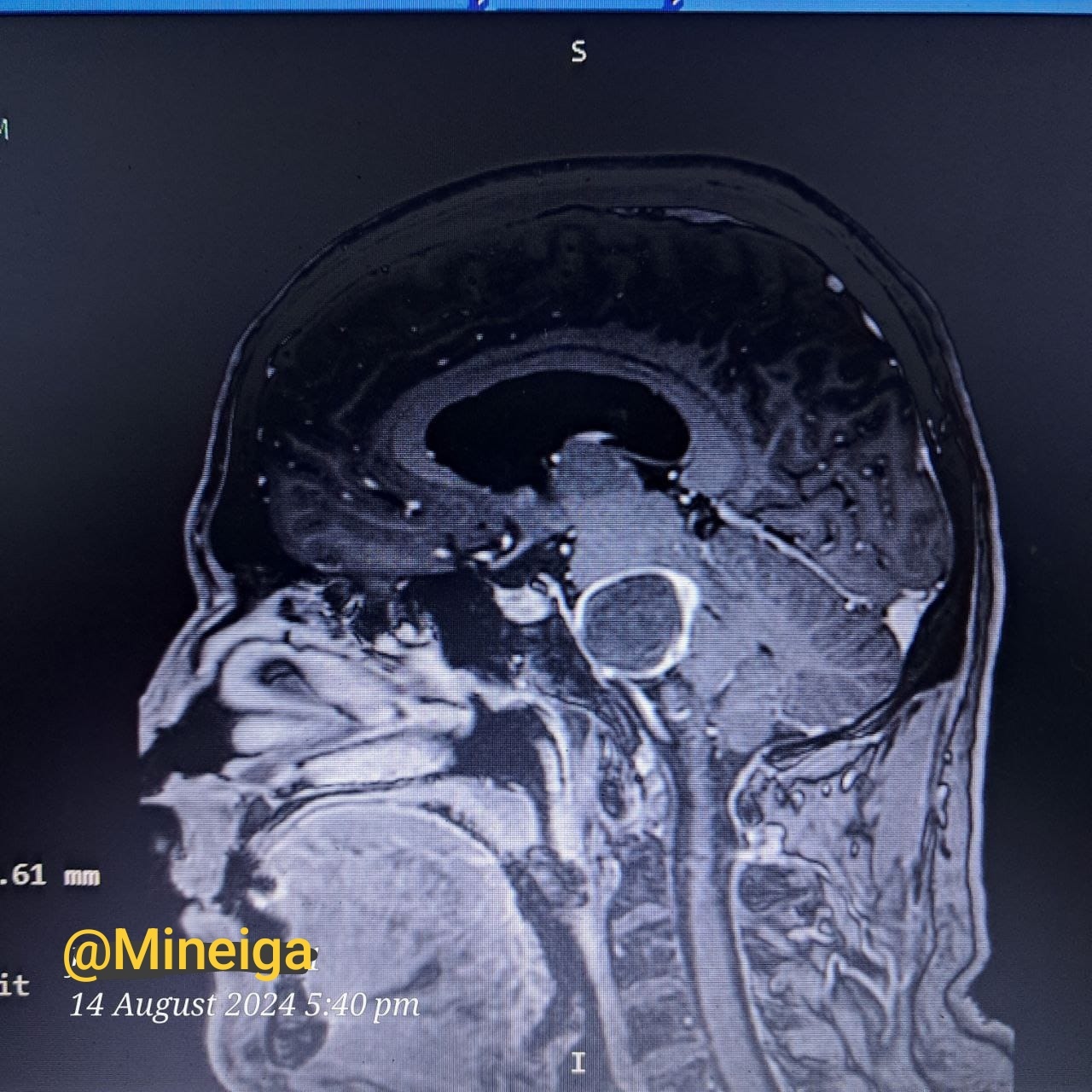 I am like this now after the removal of a 3cm tumor in the center of the brain) Thank you for your kind words! You helped!!! - My, Brain, The medicine, Longpost, Hospital, Tumor, Operation, The photo, Disease