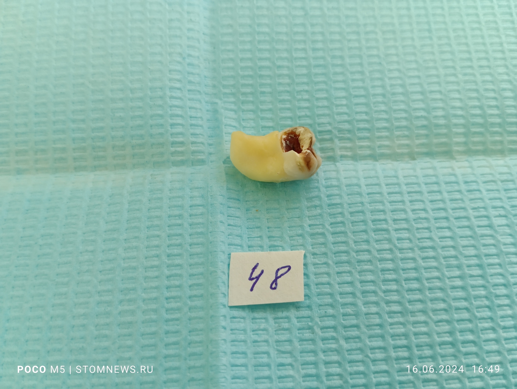 Removed 48 wisdom tooth with caries on the distal surface - My, The medicine, Dentistry, Teeth, Opinion, Doctors, Polyclinic, Medications, Treatment, Hospital, Operation, Disease, Disease history, Health