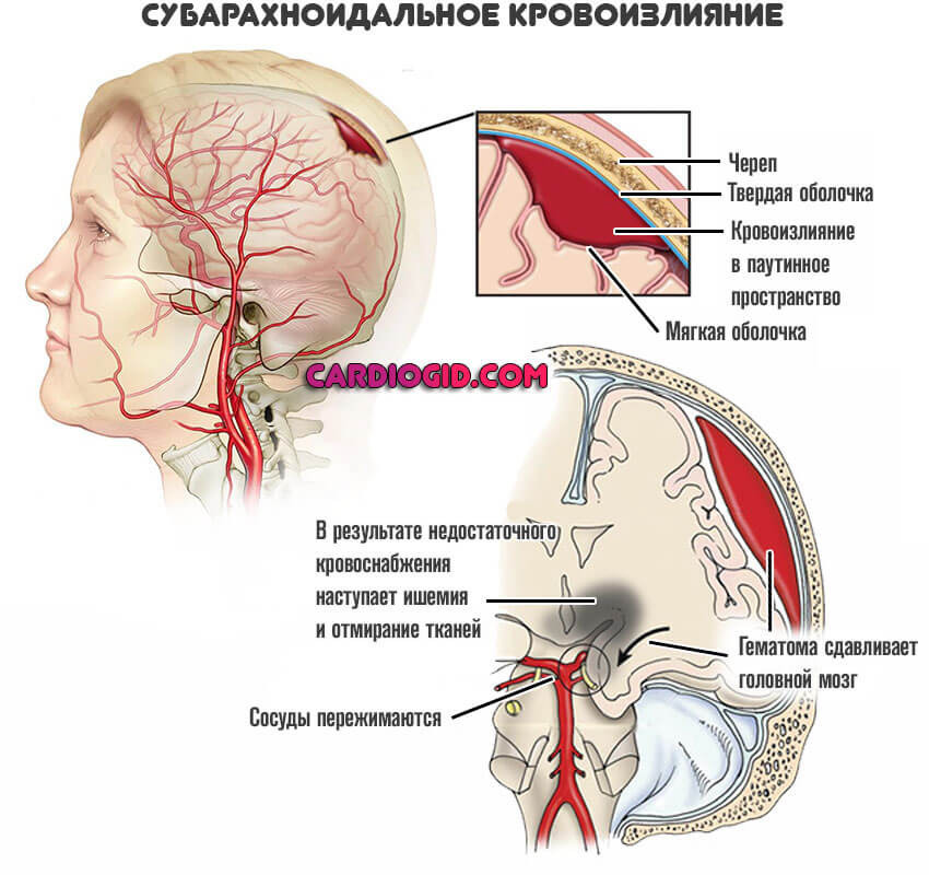 Lesson #30 Subarachnoid hemorrhage - My, The medicine, Information, Injury, Longpost