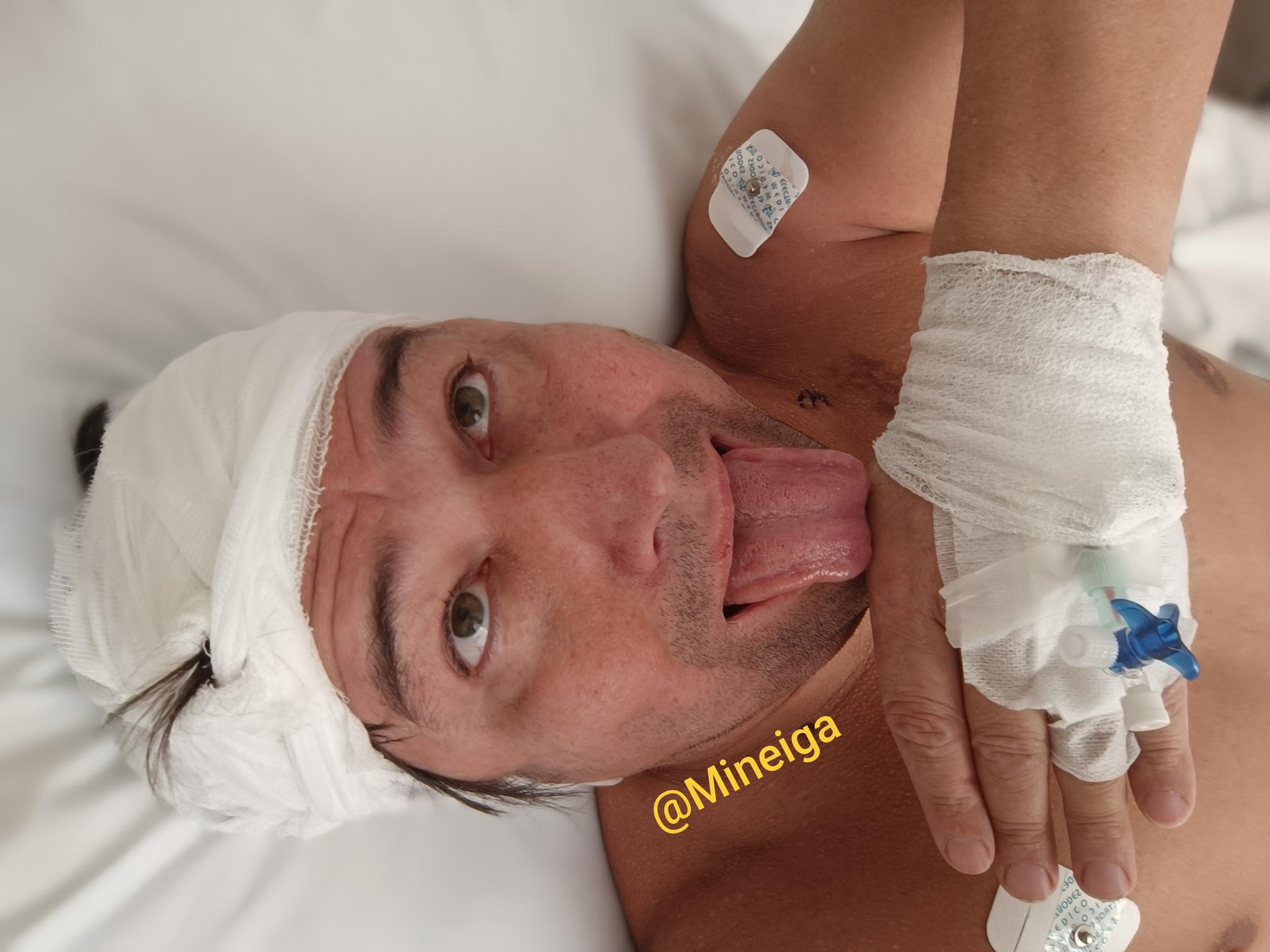 I am like this now after the removal of a 3cm tumor in the center of the brain) Thank you for your kind words! You helped!!! - My, Brain, The medicine, Longpost, Hospital, Tumor, Operation, The photo, Disease