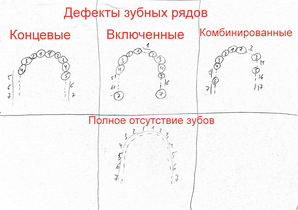 Сага о стоматологии. Глава 96. Какие бывают методы восстановления зубов? - Моё, Зубы, Врачи, Стоматология, Медицина, Протез, Здоровье, Импланты, Коронки, Лечение, Стоматолог, Беззубик, Болезнь, Проблема, Вопрос, Ответ, Длиннопост