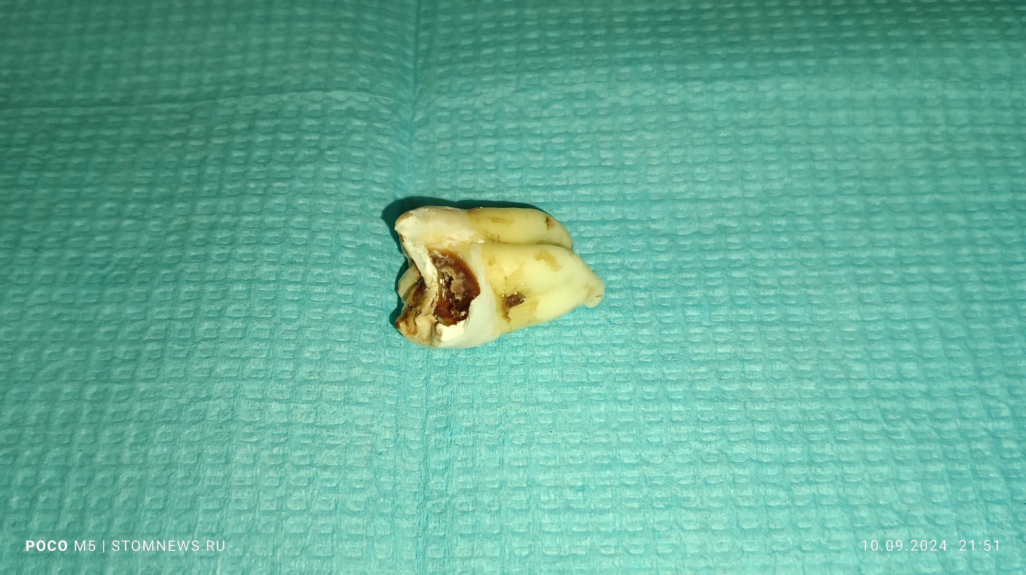 Photos of the removed 48 lower wisdom tooth with caries on the lingual surface - My, The medicine, Dentistry, Teeth, Opinion, Doctors, Polyclinic, Medications, Treatment, Disease history, Hospital, Operation, Disease, Health