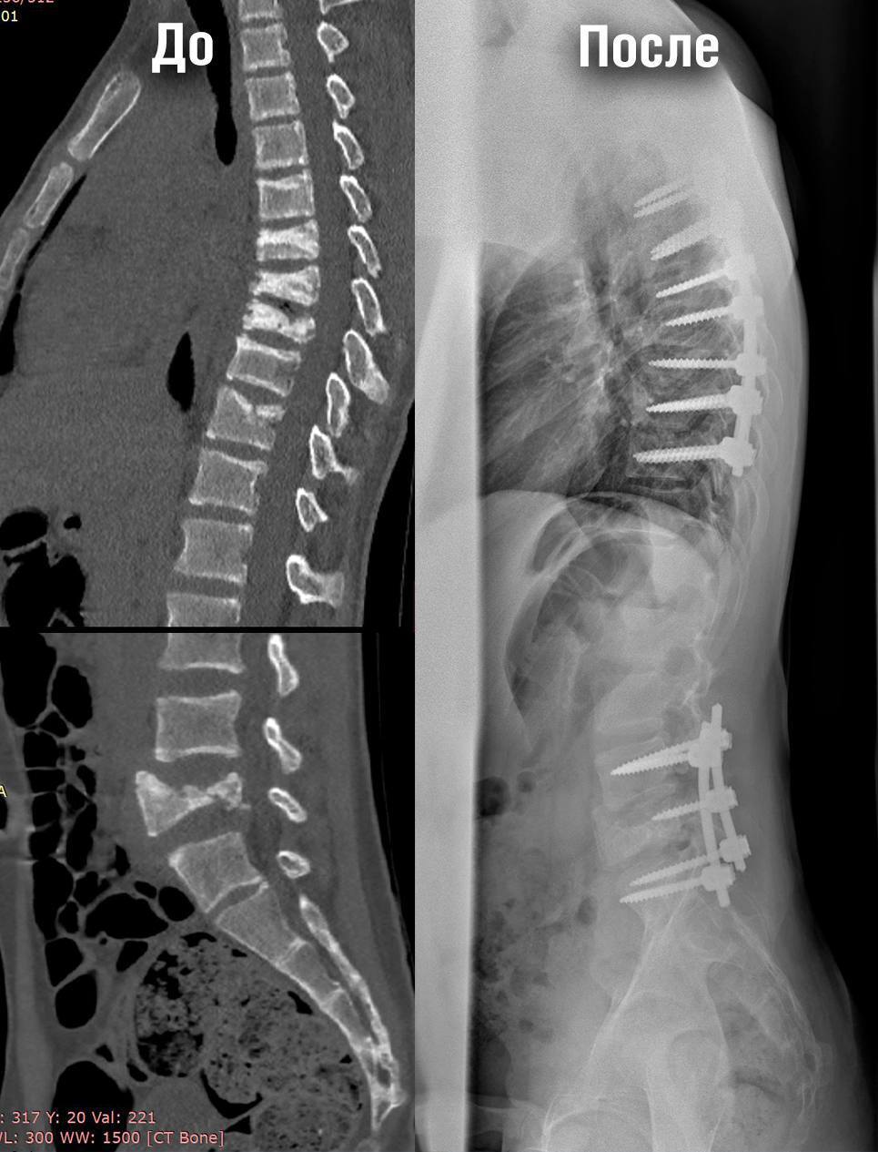 The attacks bent the child in half: Moscow doctors operated on a child with a spinal fracture caused by epilepsy - The medicine, Surgery, Operation, Health care, Epilepsy, news, Hospital, Doctors, Longpost, Telegram (link)