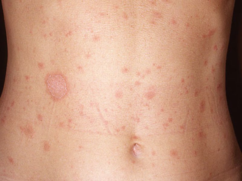 From the practice of a pediatrician: what kind of rash is this? - My, The medicine, Health, Rash, Doctors, Pediatrician, Longpost, Dermatology, Rare diseases