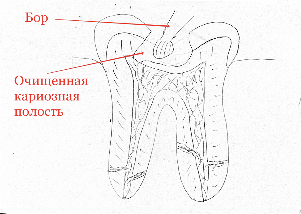 Сага о стоматологии. Глава 97. Как удаляют нерв из зуба? - Моё, Стоматология, Зубы, Нервы, Медицина, Врачи, Здоровье, Стоматолог, Работа, Канал, Операция, Лекарства, Вопрос, Ответ, Поликлиника, Длиннопост