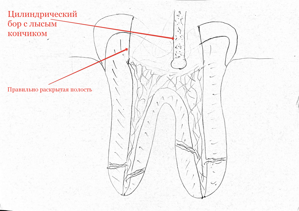 Сага о стоматологии. Глава 97. Как удаляют нерв из зуба? - Моё, Стоматология, Зубы, Нервы, Медицина, Врачи, Здоровье, Стоматолог, Работа, Канал, Операция, Лекарства, Вопрос, Ответ, Поликлиника, Длиннопост
