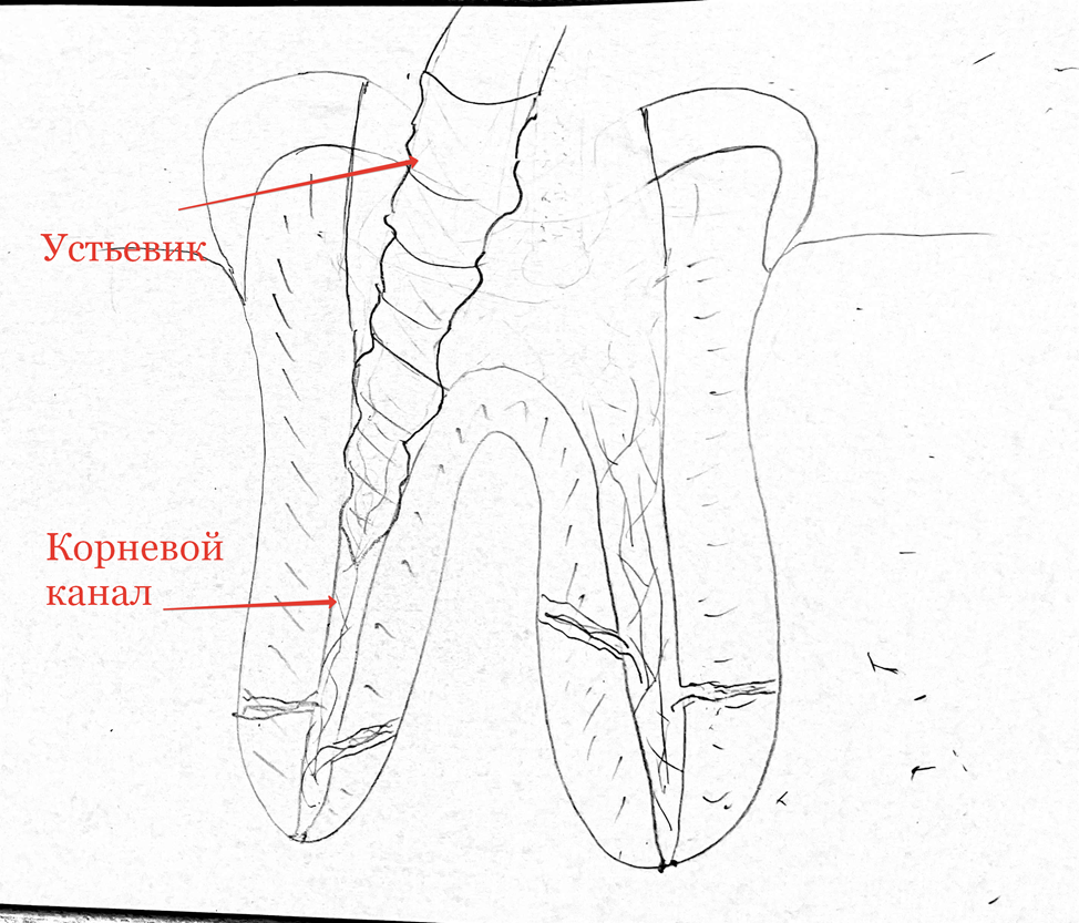 Сага о стоматологии. Глава 97. Как удаляют нерв из зуба? - Моё, Стоматология, Зубы, Нервы, Медицина, Врачи, Здоровье, Стоматолог, Работа, Канал, Операция, Лекарства, Вопрос, Ответ, Поликлиника, Длиннопост