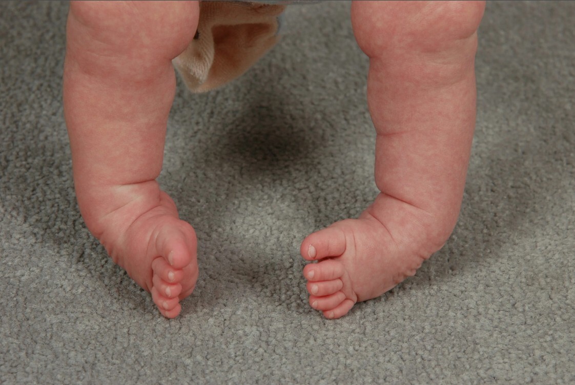 Clubfoot and clubfoot - My, The medicine, Health, Talipes, Feet, Longpost, Children