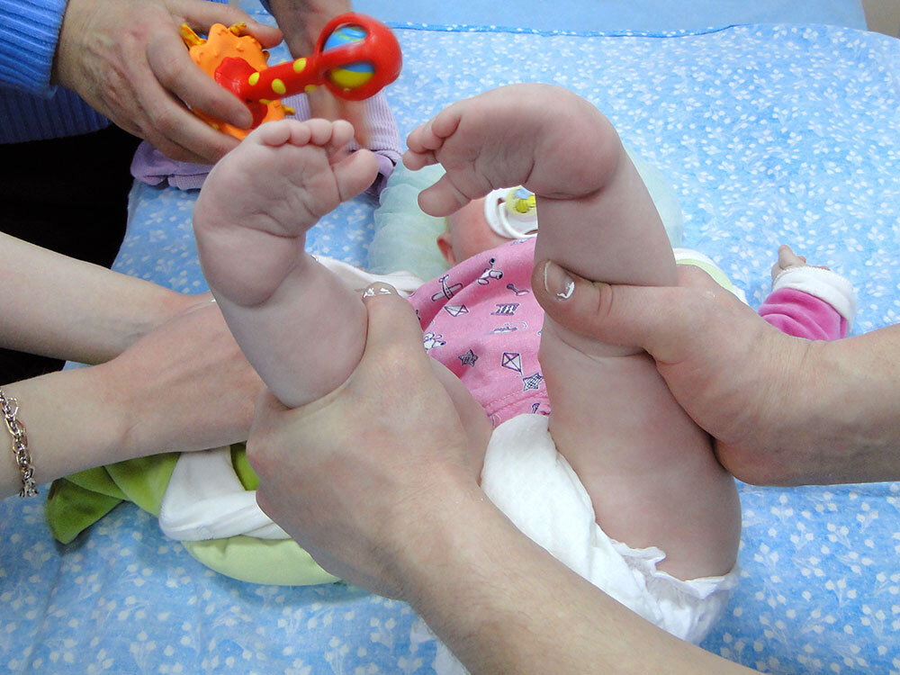 Clubfoot and clubfoot - My, The medicine, Health, Talipes, Feet, Longpost, Children