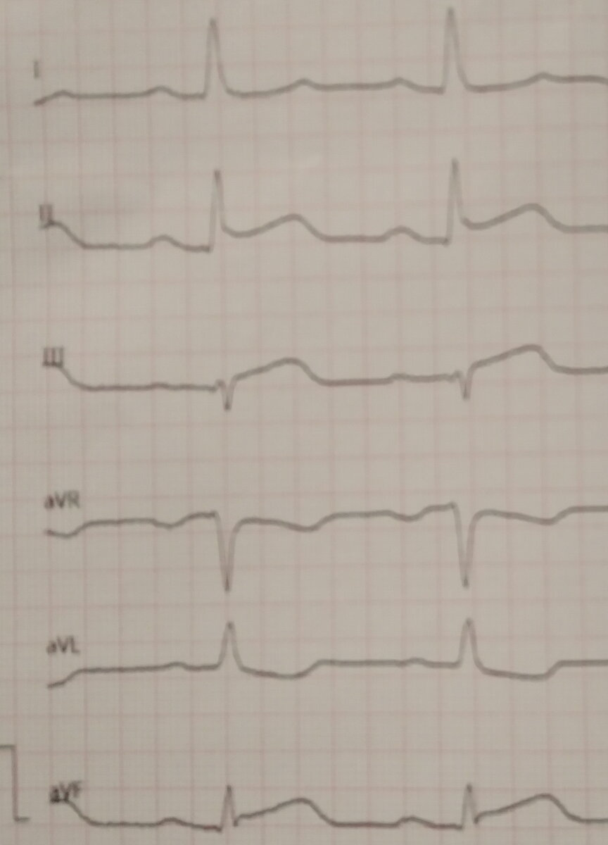 Инфаркт миокарда у 19-летнего пациента - Врачи, Скорая помощь, История болезни, Яндекс Дзен, Яндекс Дзен (ссылка), Длиннопост