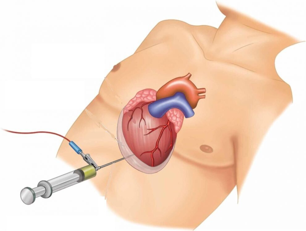 Stab wound to the heart. An unusual case in intensive care - Doctors, Ambulance, Negative, Disease history, Yandex Zen, Yandex Zen (link), Longpost