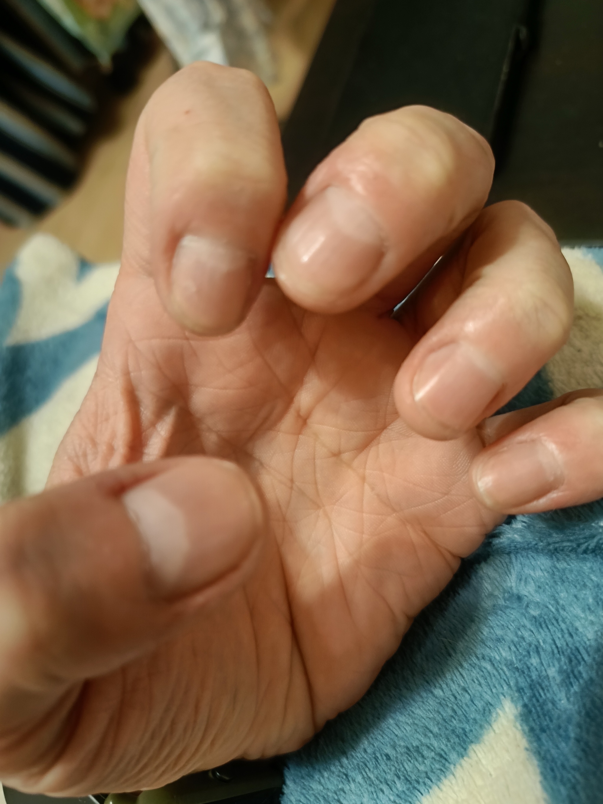 Let's bite our nails together - My, Nails, Bad habits, Longpost