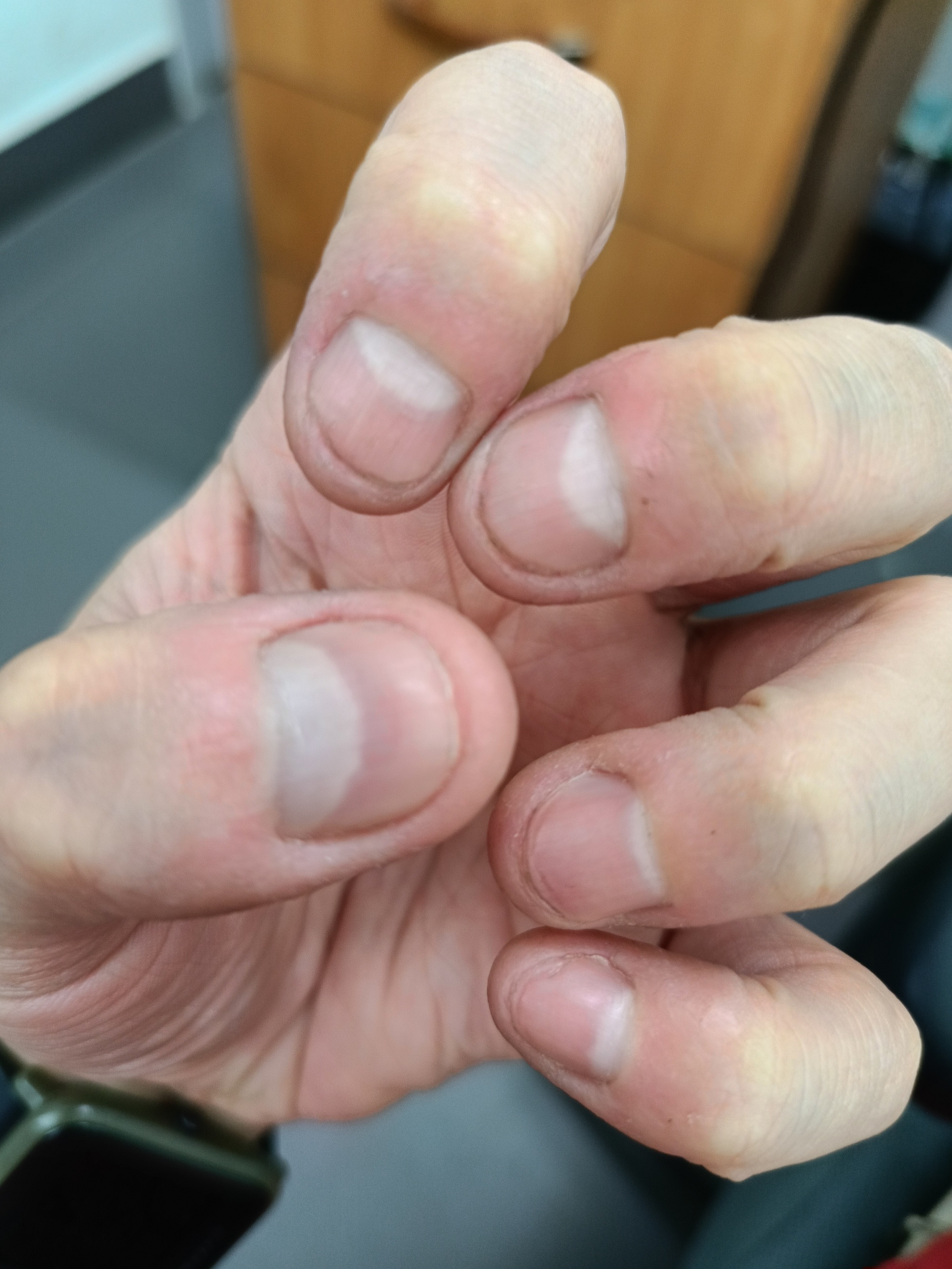 Let's bite our nails together - My, Nails, Bad habits, Longpost