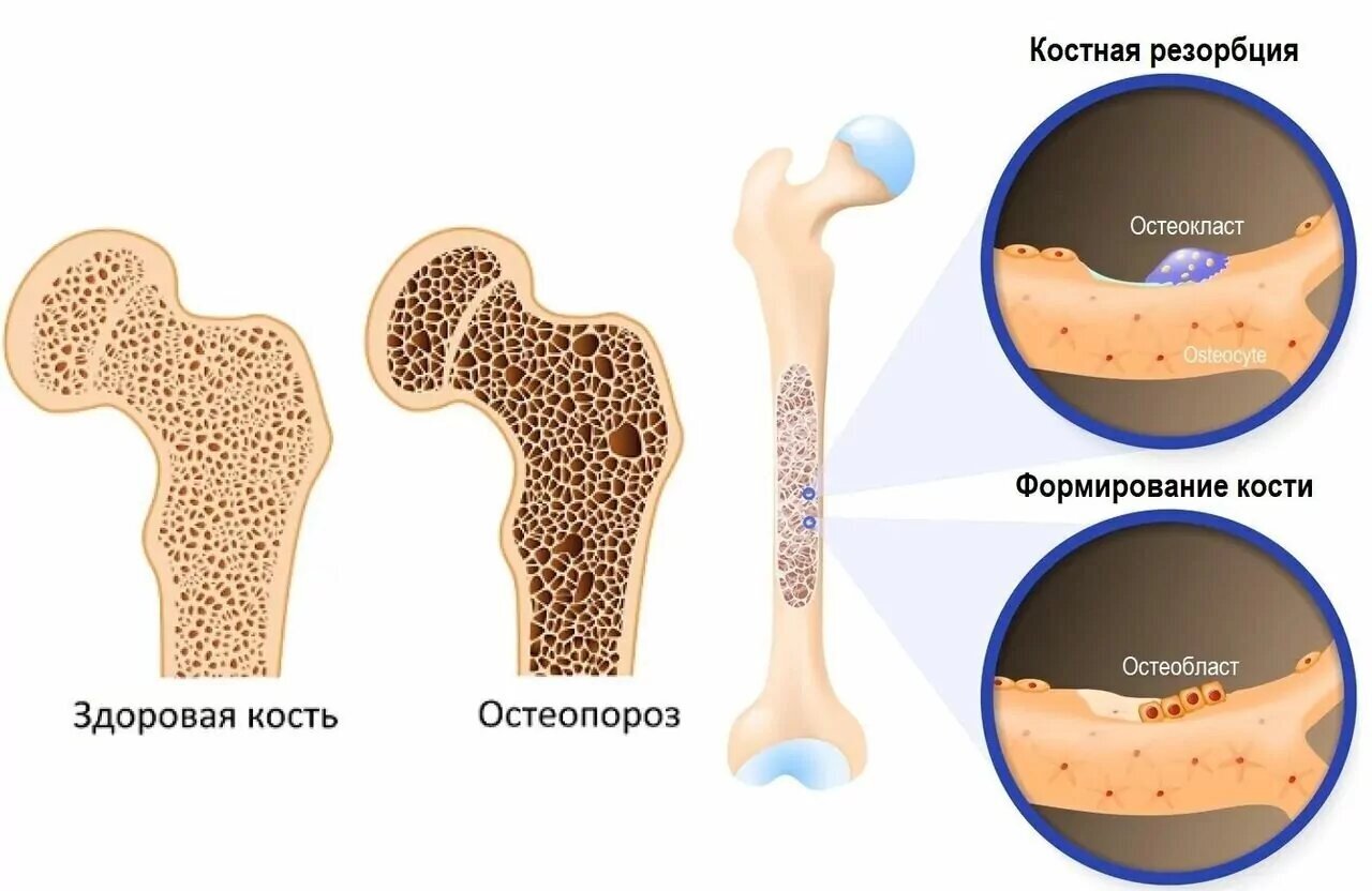 Top 5 Bone Supplements - Research, Health, Healthy lifestyle, Calcium, Magnesium, Vitamin D, Telegram (link), VKontakte (link), Longpost, Bones