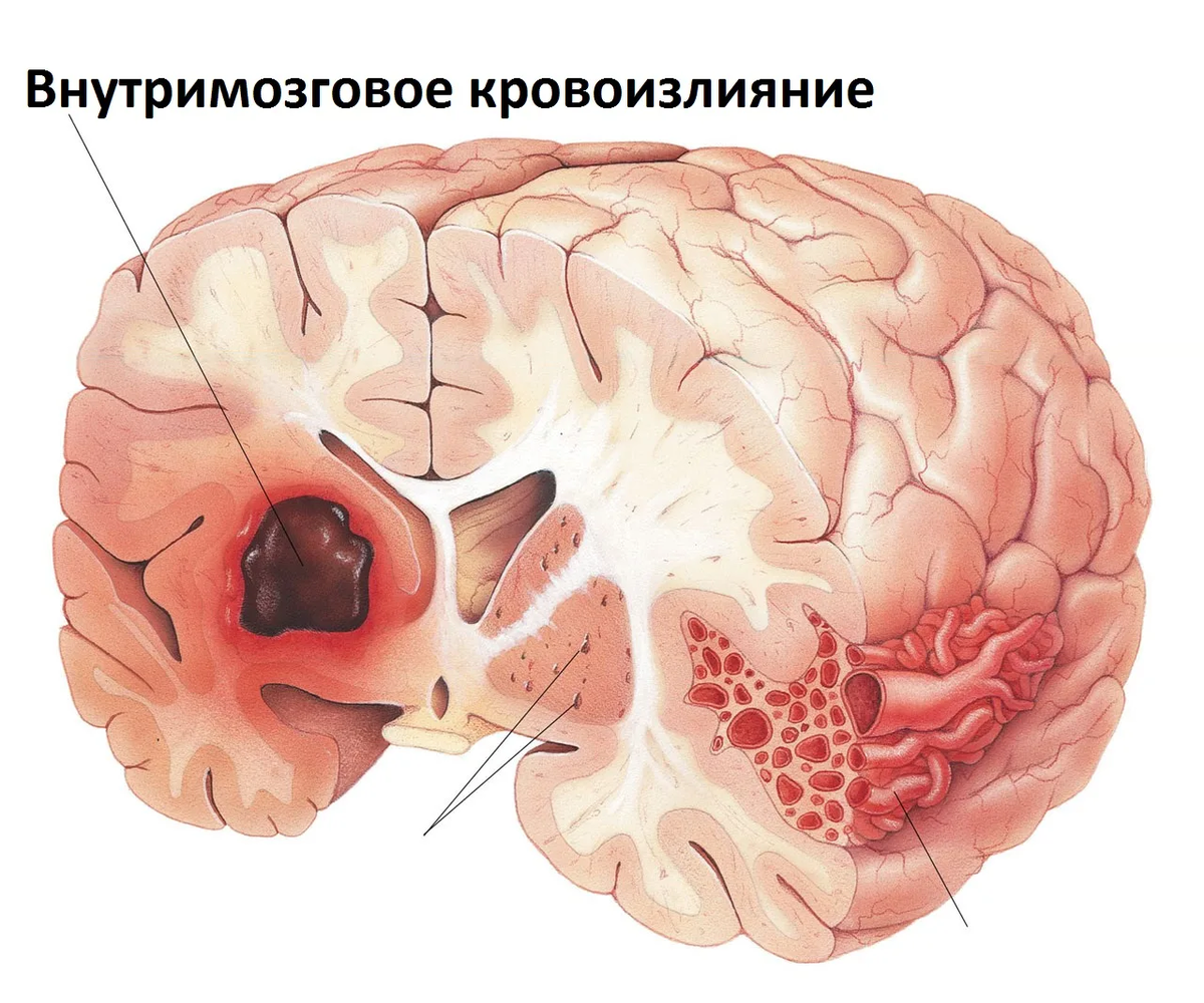 Lesson #31 Intracerebral hemorrhage - My, The medicine, Information, Longpost