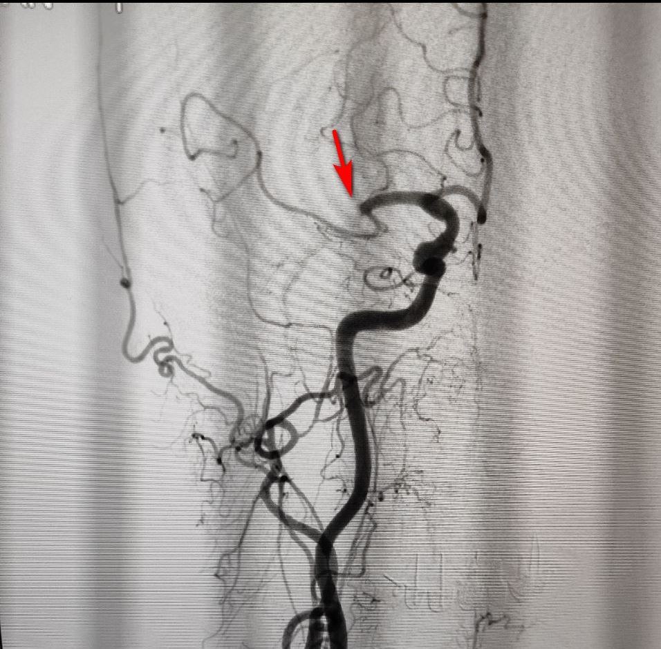 Treatment of ischemic stroke in pictures - My, The medicine, Images, Good, Thrombus, Stroke, Longpost, Video, Vertical video