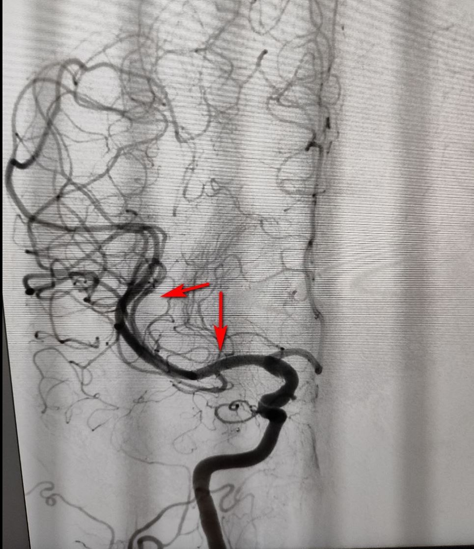 Treatment of ischemic stroke in pictures - My, The medicine, Images, Good, Thrombus, Stroke, Longpost, Video, Vertical video