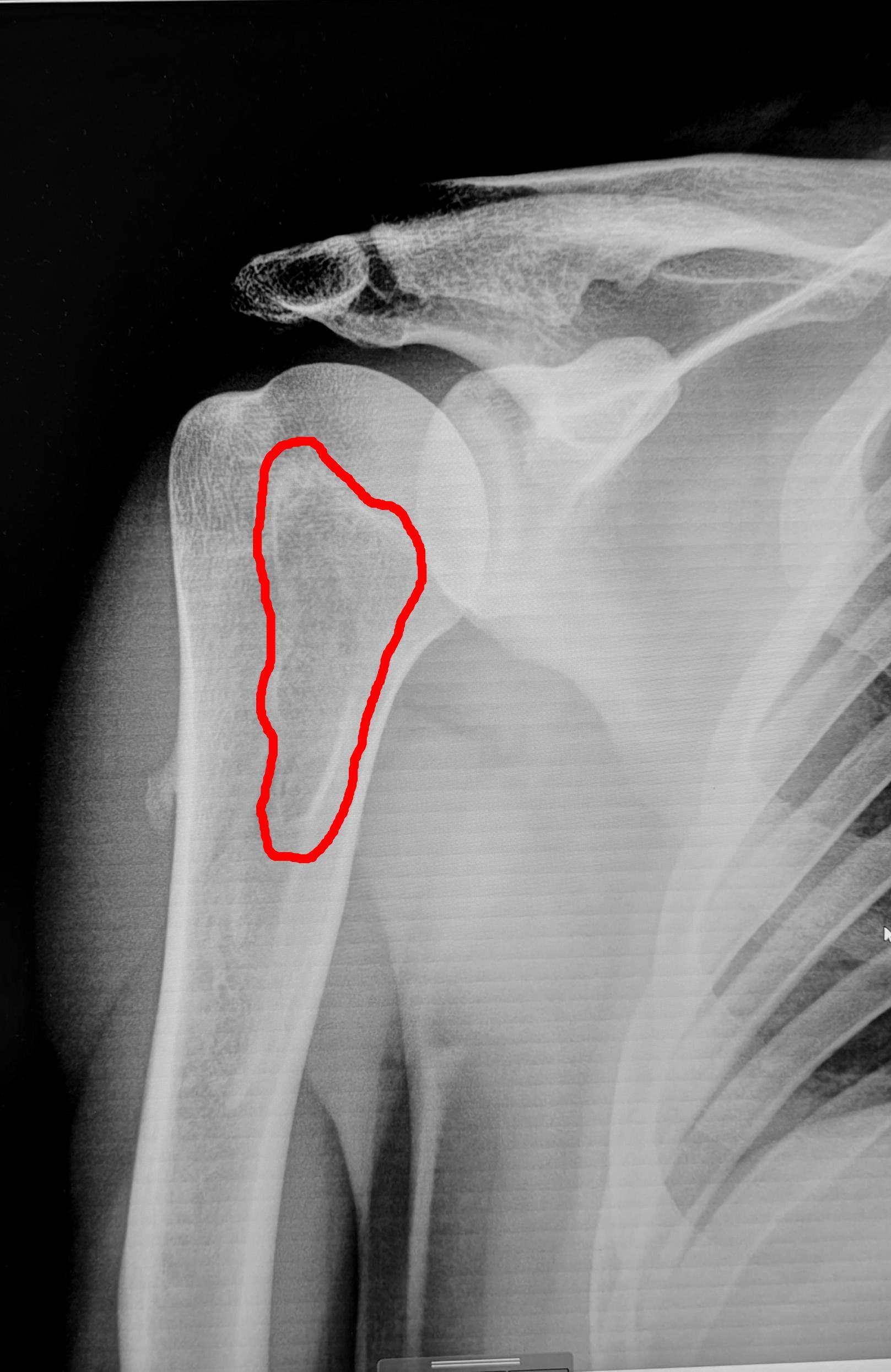 Bone cyst of the humerus - My, The medicine, Army, Cyst, Bones, X-ray, Radiology, Conscripts, Military enlistment office, Longpost