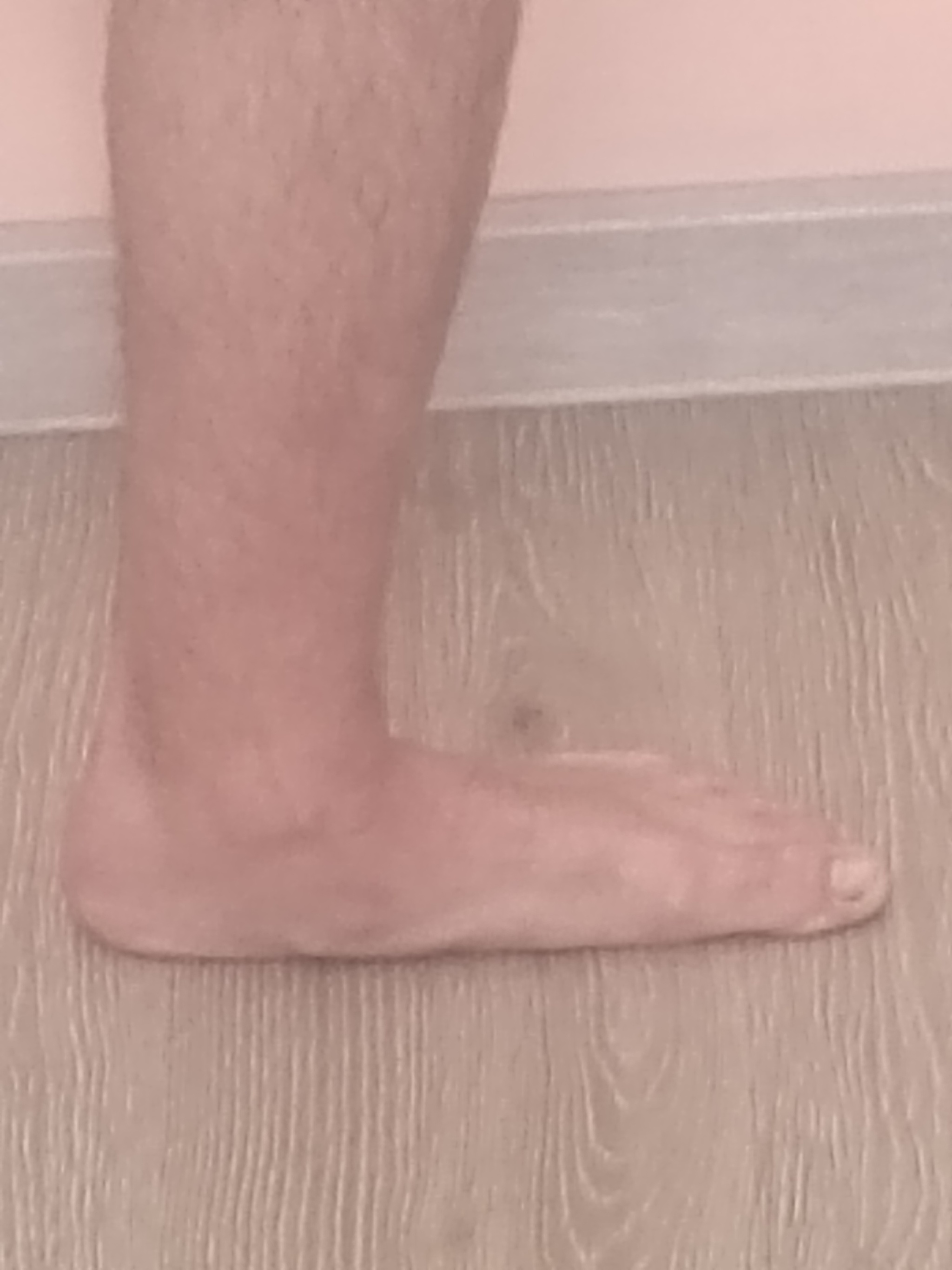 FLAT FEET - looks like 3rd degree? - Question, Ask Peekaboo