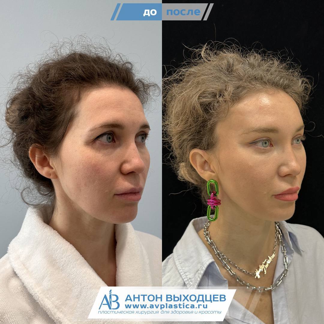 Endoscopic Facelift Before and After - My, Operation, Moscow, It Was-It Was, Plastic surgery, Surgery, Surgeon, Eyes, beauty, Saint Petersburg, Endoscopy, Blepharoplasty, Bags under the eyes, Longpost