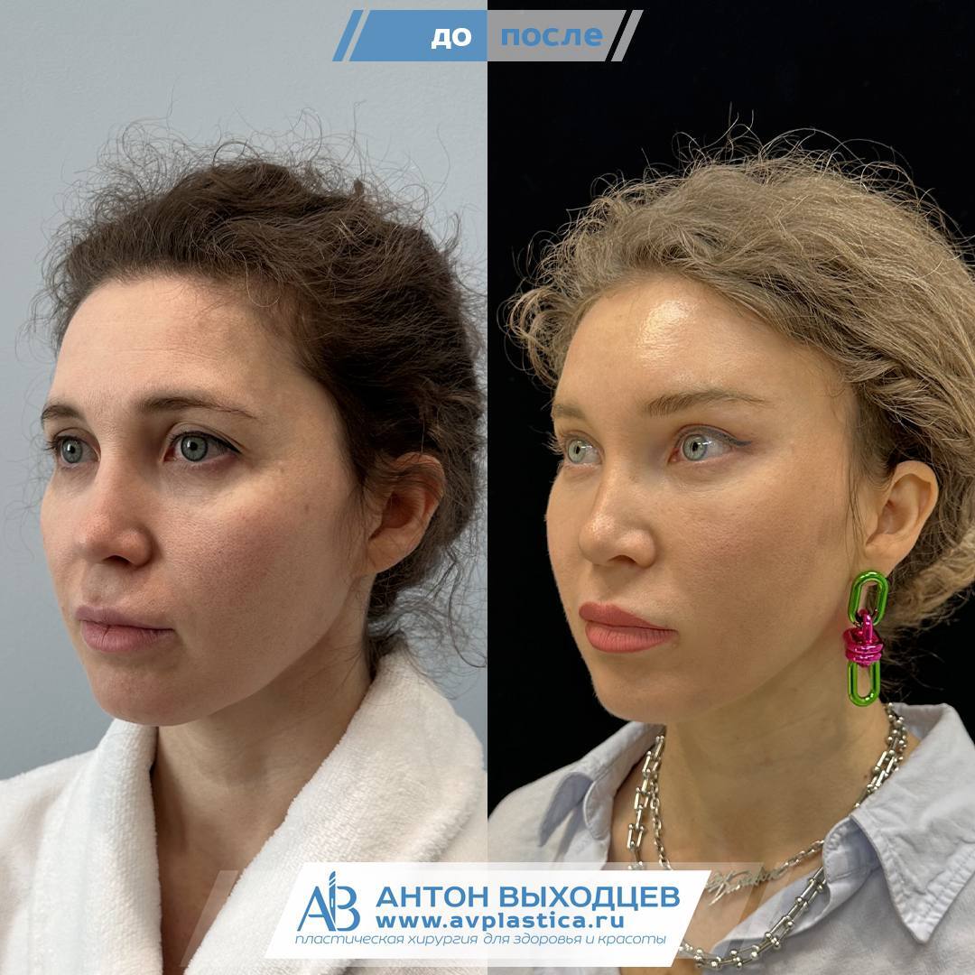 Endoscopic Facelift Before and After - My, Operation, Moscow, It Was-It Was, Plastic surgery, Surgery, Surgeon, Eyes, beauty, Saint Petersburg, Endoscopy, Blepharoplasty, Bags under the eyes, Longpost