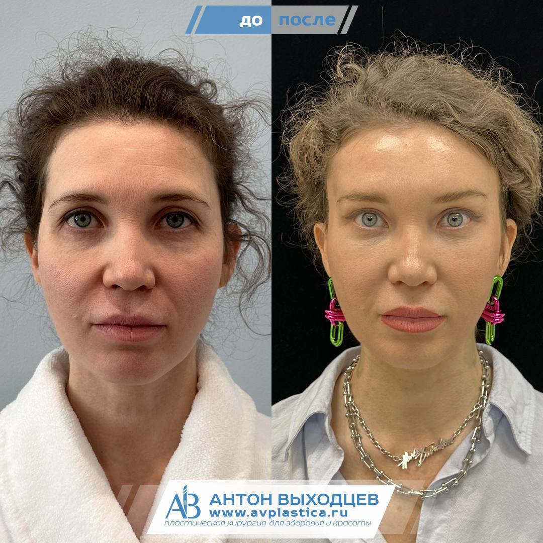 Endoscopic Facelift Before and After - My, Operation, Moscow, It Was-It Was, Plastic surgery, Surgery, Surgeon, Eyes, beauty, Saint Petersburg, Endoscopy, Blepharoplasty, Bags under the eyes, Longpost