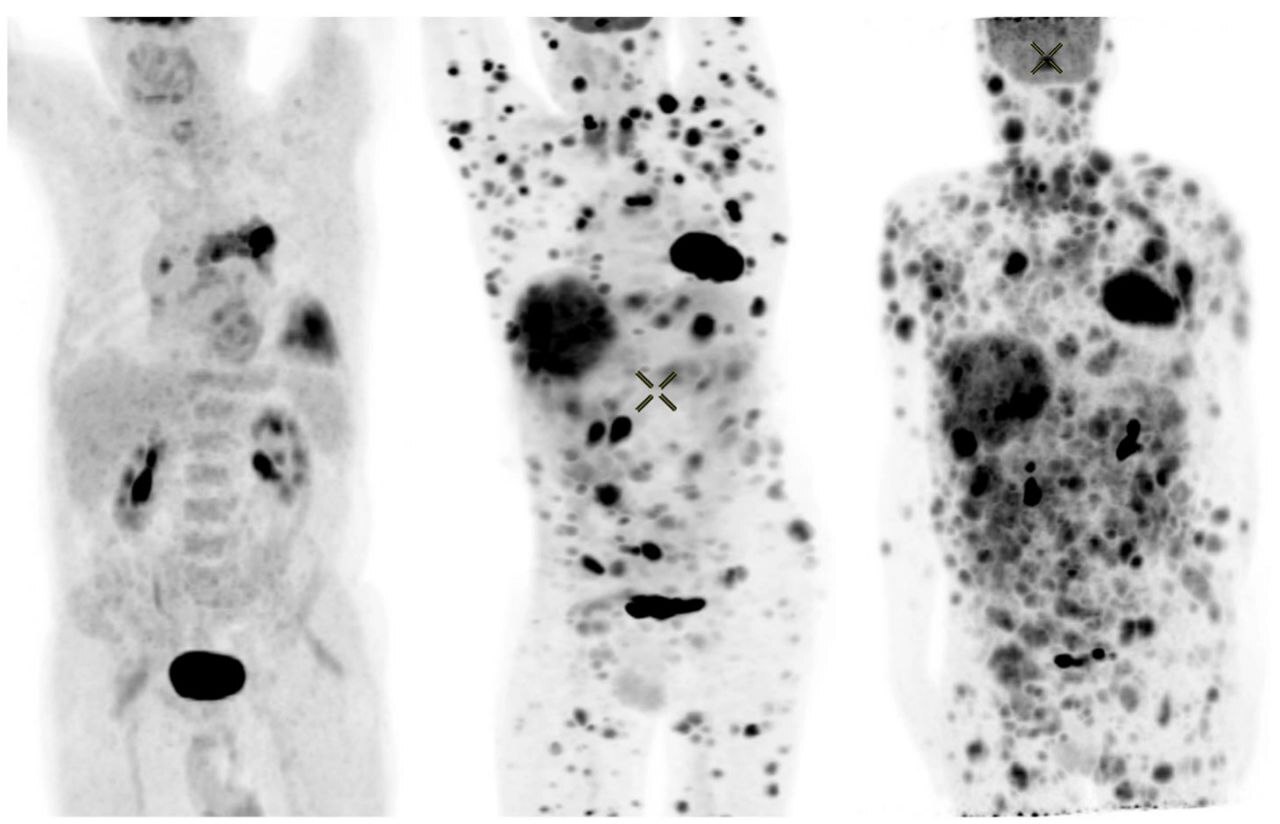 Melanoma - The medicine, Cancer and oncology, Health, Melanoma, The sun