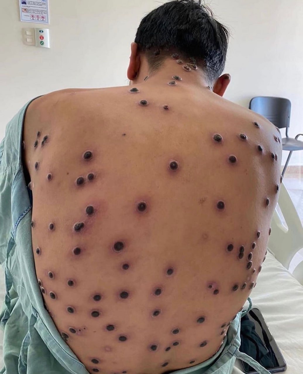 Skin lesions in monkeypox - The medicine, Disease, Longpost