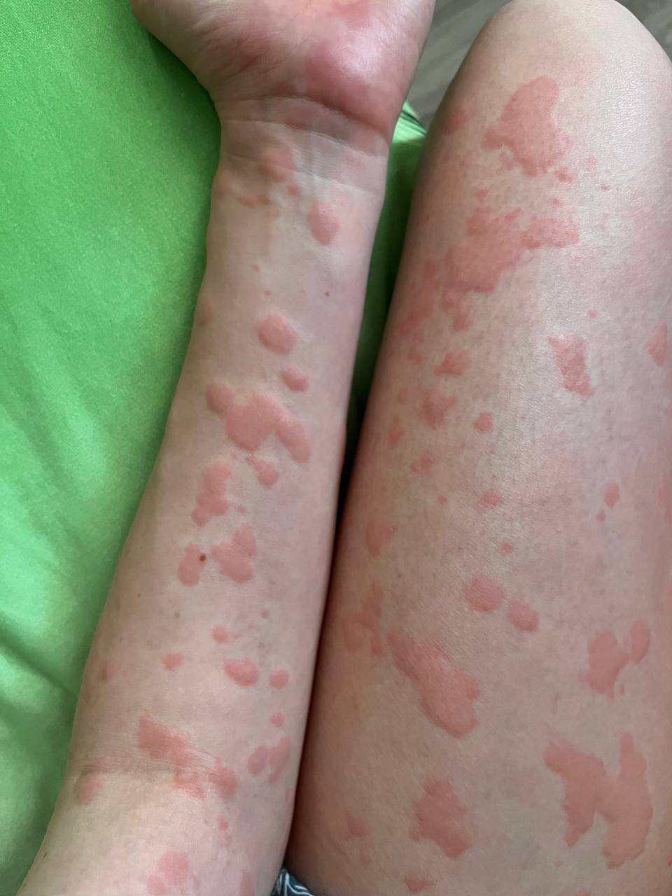 Two years of chronic urticaria. Spots all over the body - My, Disease history, Cholinergic urticaria, Hives, Allergy, Question, Ask Peekaboo, Longpost