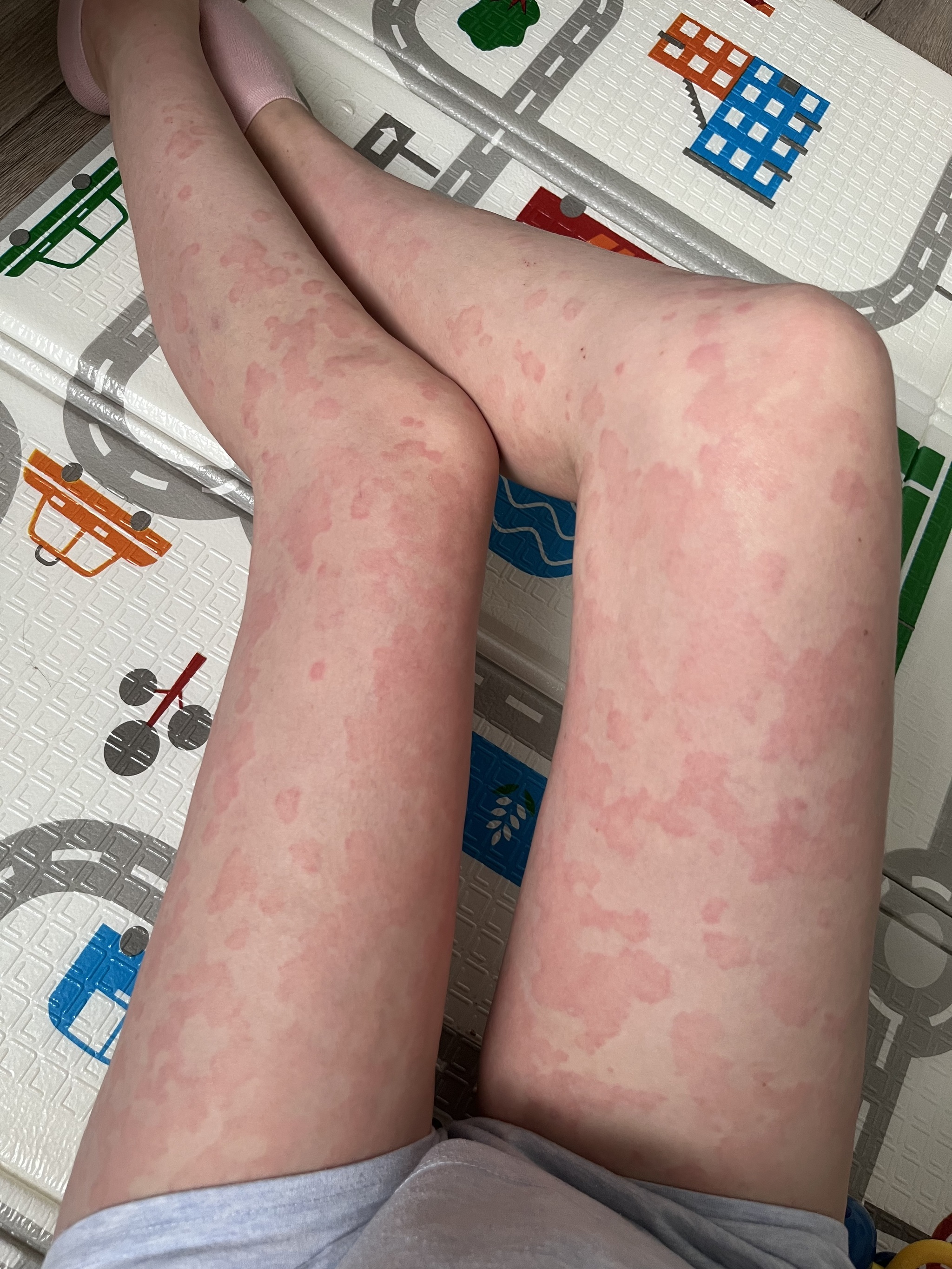 Two years of chronic urticaria. Spots all over the body - My, Disease history, Cholinergic urticaria, Hives, Allergy, Question, Ask Peekaboo, Longpost