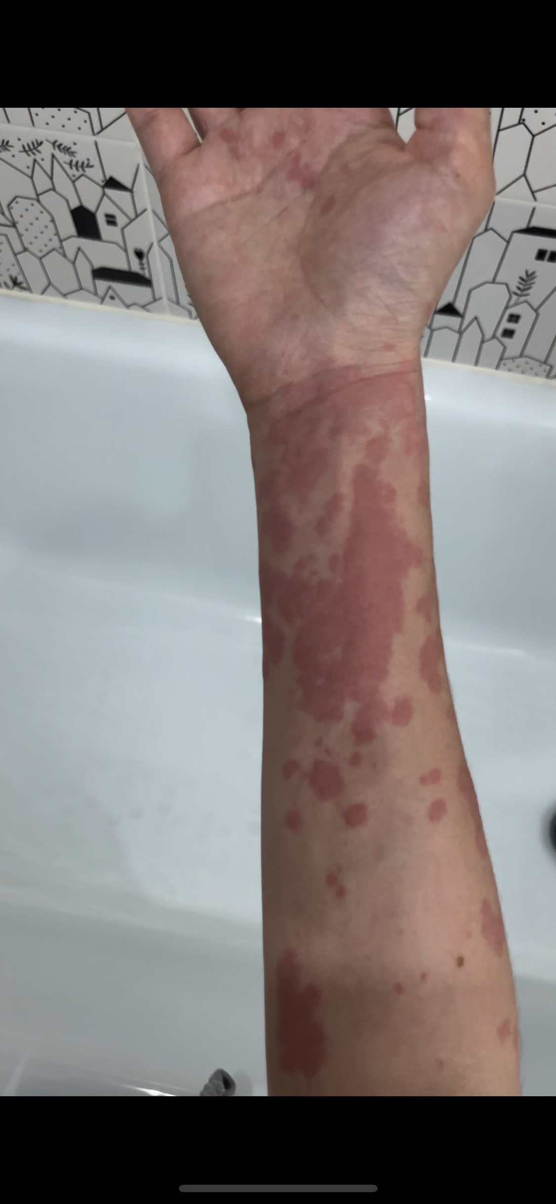 Two years of chronic urticaria. Spots all over the body - My, Disease history, Cholinergic urticaria, Hives, Allergy, Question, Ask Peekaboo, Longpost