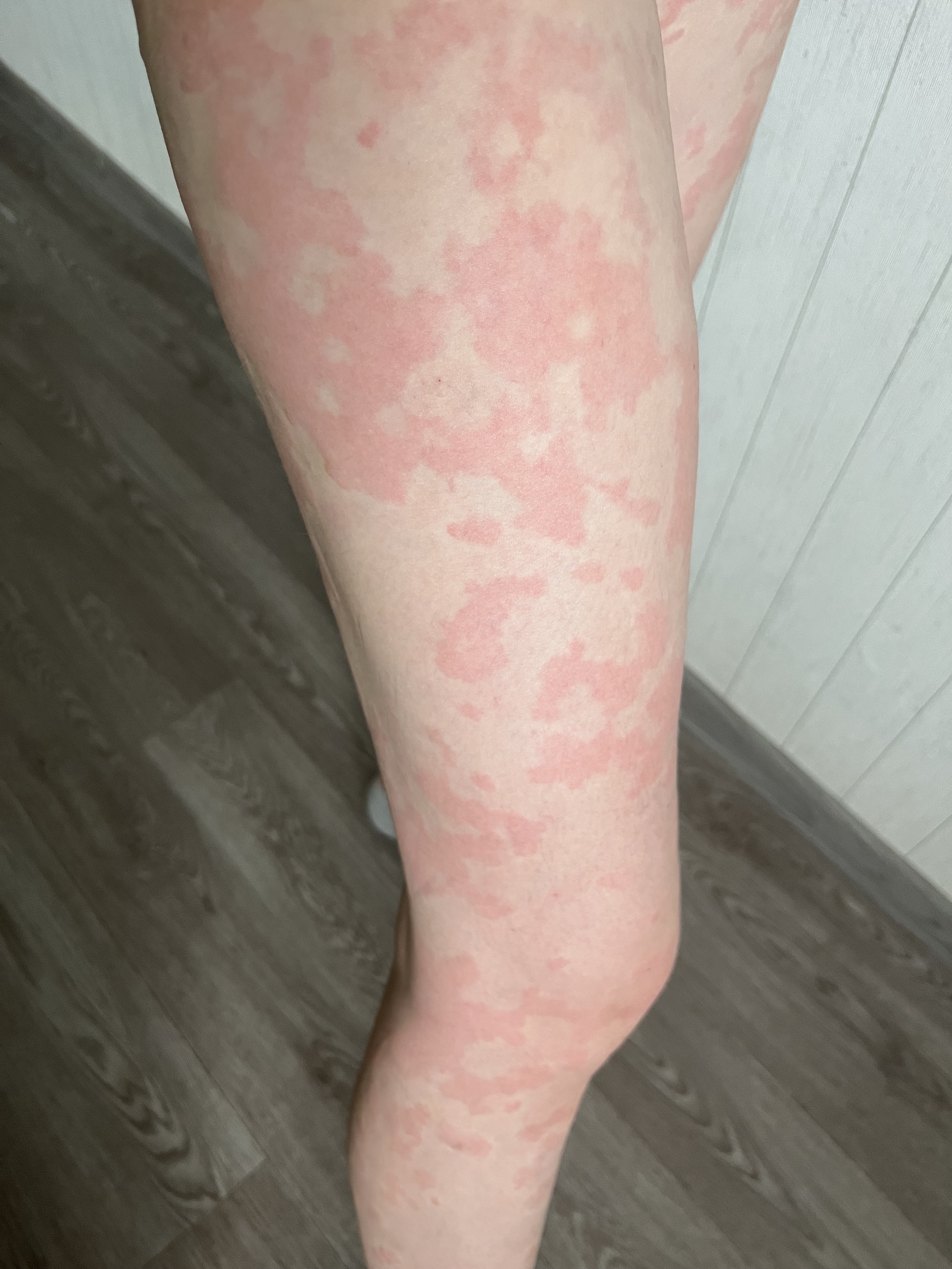 Two years of chronic urticaria. Spots all over the body - My, Disease history, Cholinergic urticaria, Hives, Allergy, Question, Ask Peekaboo, Longpost