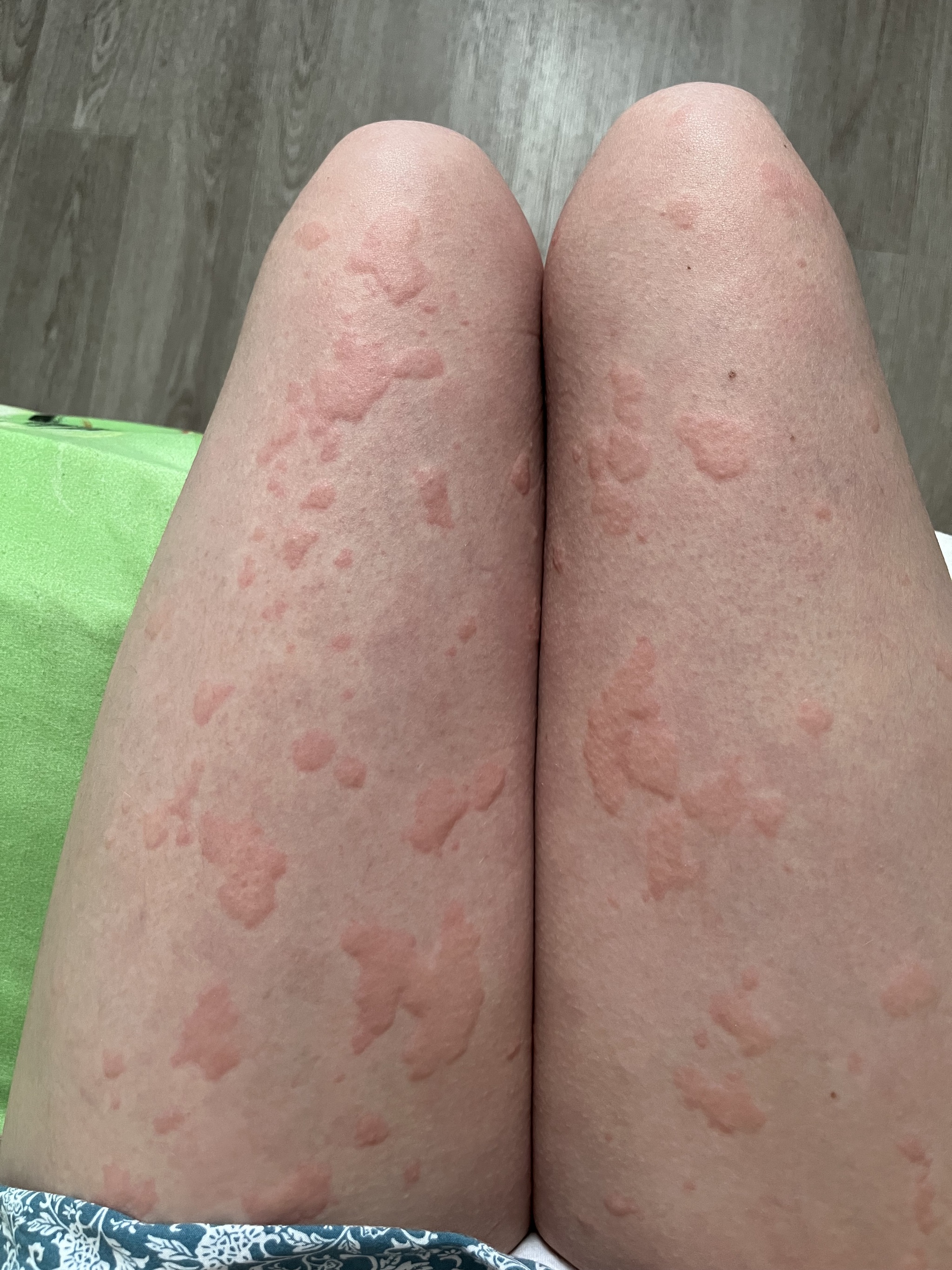 Two years of chronic urticaria. Spots all over the body - My, Disease history, Cholinergic urticaria, Hives, Allergy, Question, Ask Peekaboo, Longpost