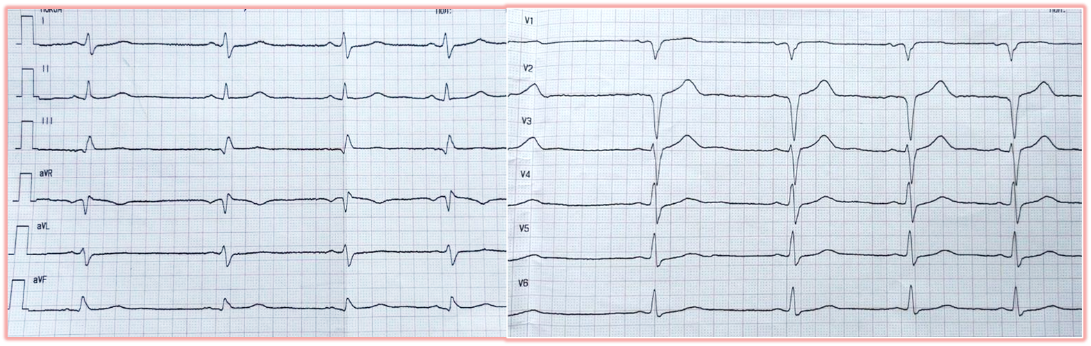 Heart attack at 21? Yes! - My, The medicine, Treatment, Health, Heart attack, Operation, Heart, No rating, Video, Soundless, Longpost