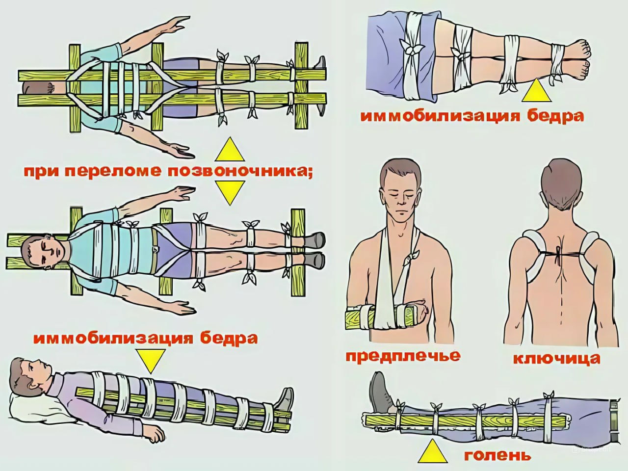 Подборка фиксаций конечностей - Выживание, Обучение, Поход, Путешествия, Важно, Фиксация, Травма, Перелом, Перевязка, Помощь, Правила, Части тела, Действия, Опасность, Заживление, Борьба за выживание, Ключицы, Бедра