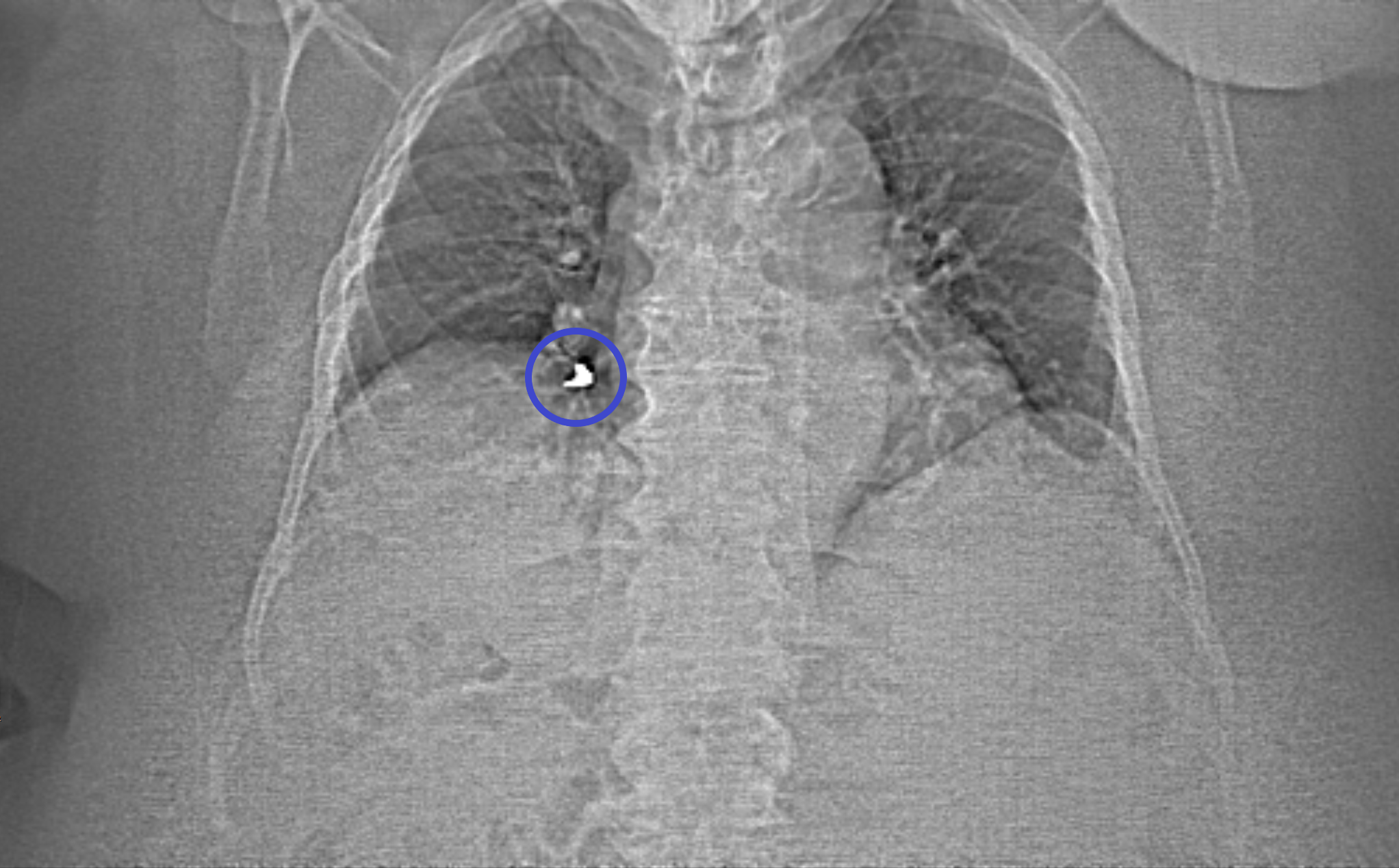 Case Studies: Slow-Acting Filling - My, Personal experience, Seal, CT, Pneumonia, Foreign body, Lungs, Radiology, Longpost