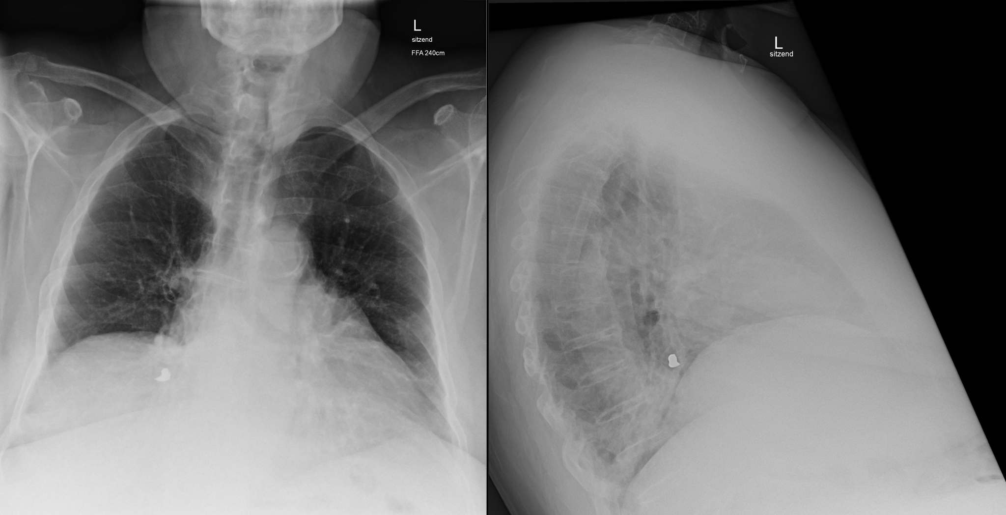 Case Studies: Slow-Acting Filling - My, Personal experience, Seal, CT, Pneumonia, Foreign body, Lungs, Radiology, Longpost