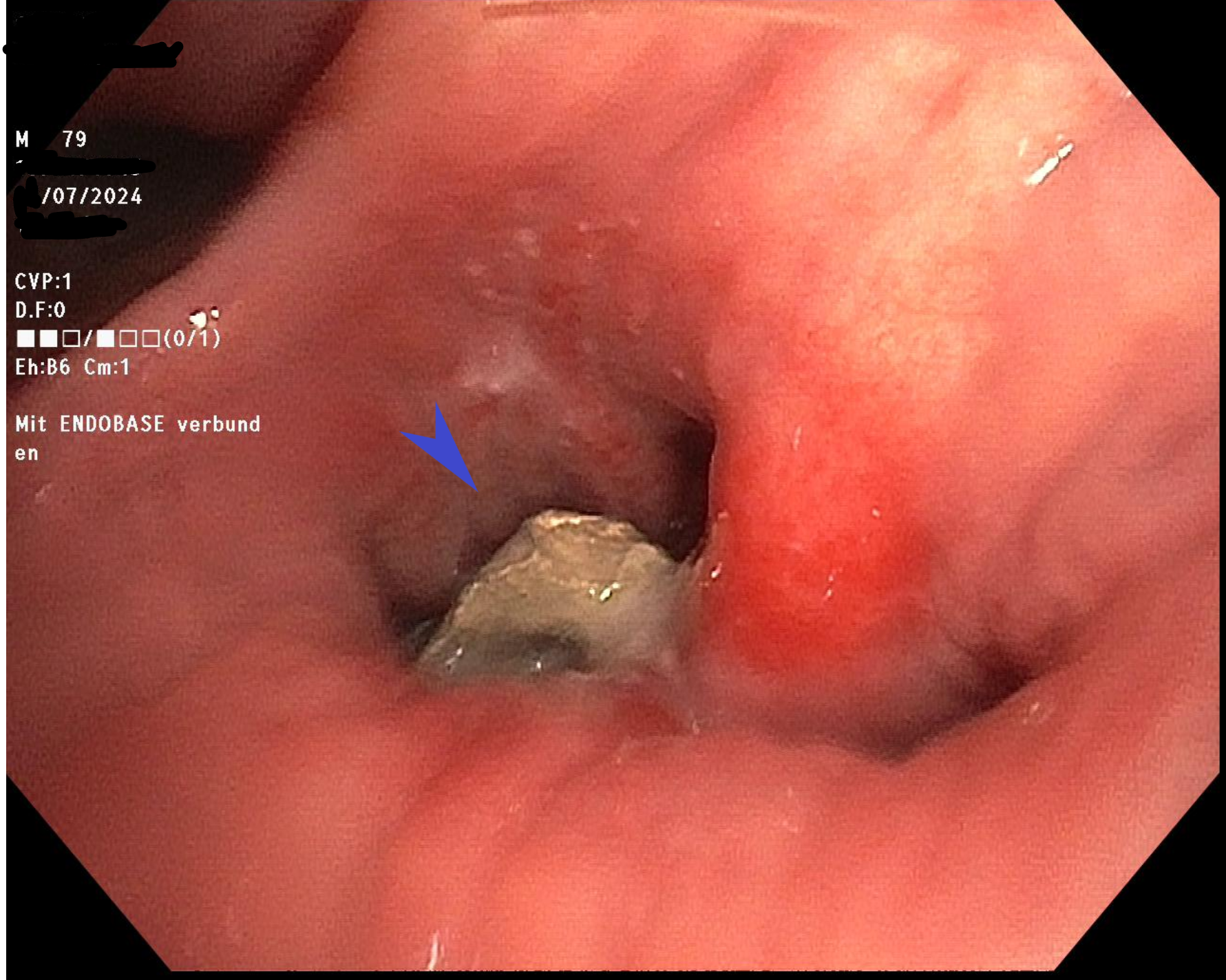 Case Studies: Slow-Acting Filling - My, Personal experience, Seal, CT, Pneumonia, Foreign body, Lungs, Radiology, Longpost