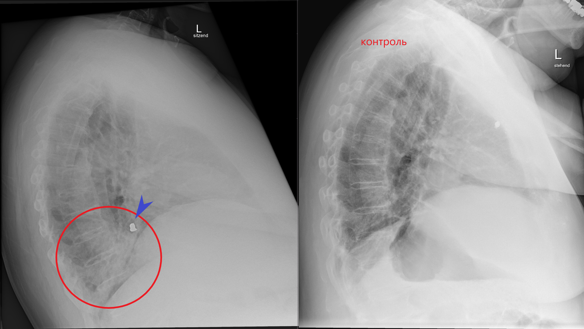 Case Studies: Slow-Acting Filling - My, Personal experience, Seal, CT, Pneumonia, Foreign body, Lungs, Radiology, Longpost