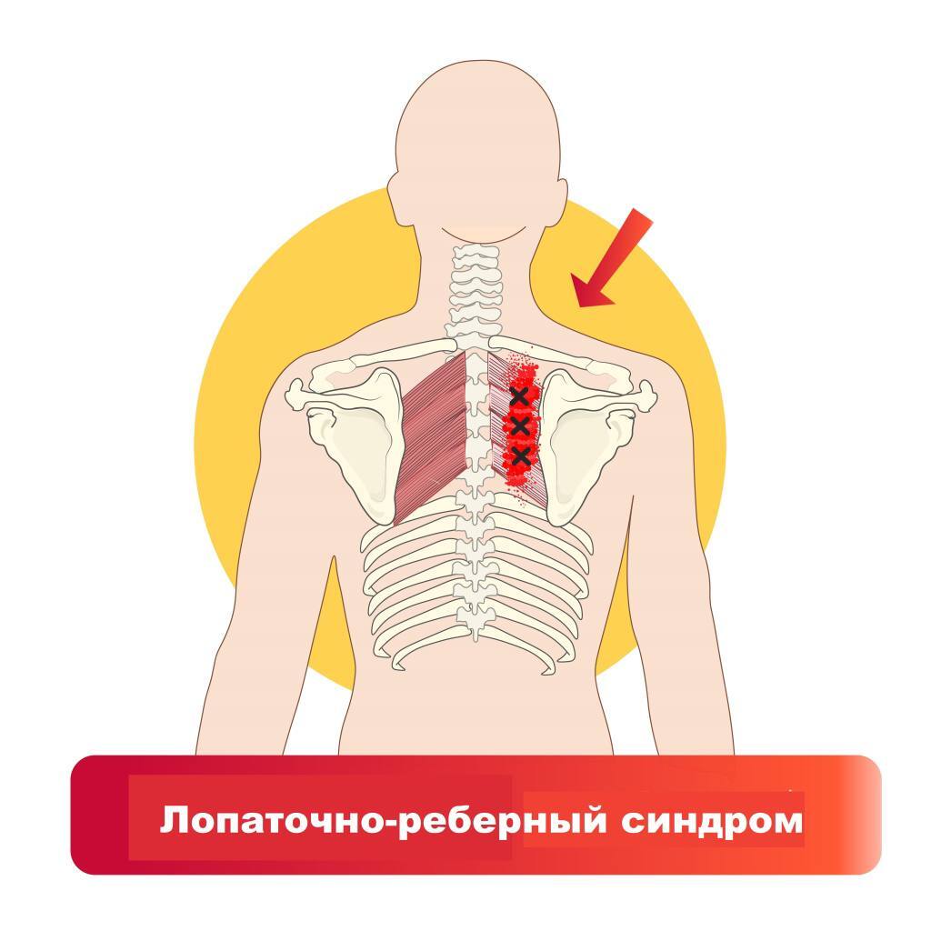 Pain under the shoulder blade. Causes and solution to the problem! - My, Massage, Notes of a massage therapist, Masseur