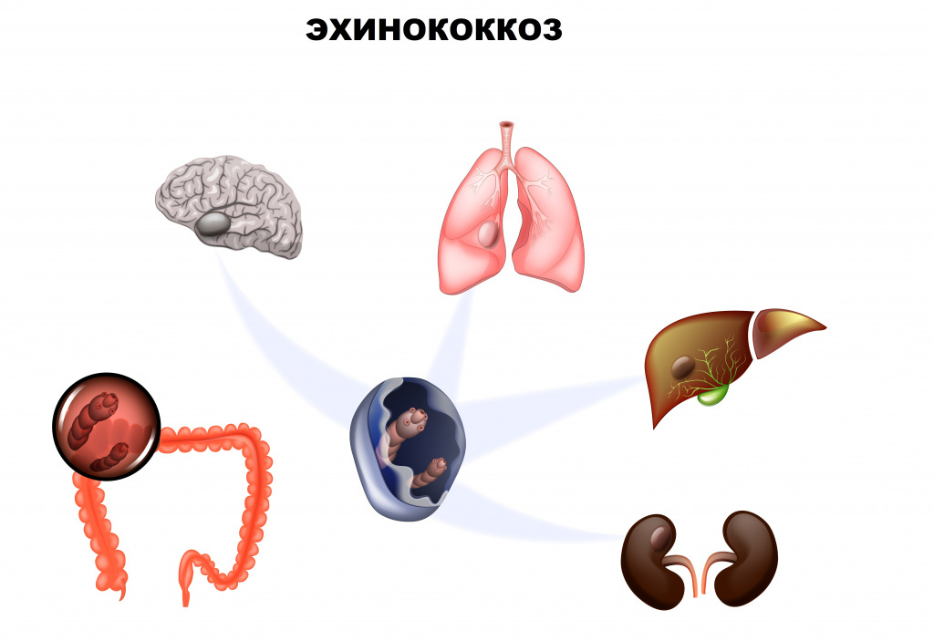 Worms that will kill you (or rather their larvae) - My, Health, Treatment, Worm, Larva, Cyst, Operation, Disease, Echinococcus, Longpost