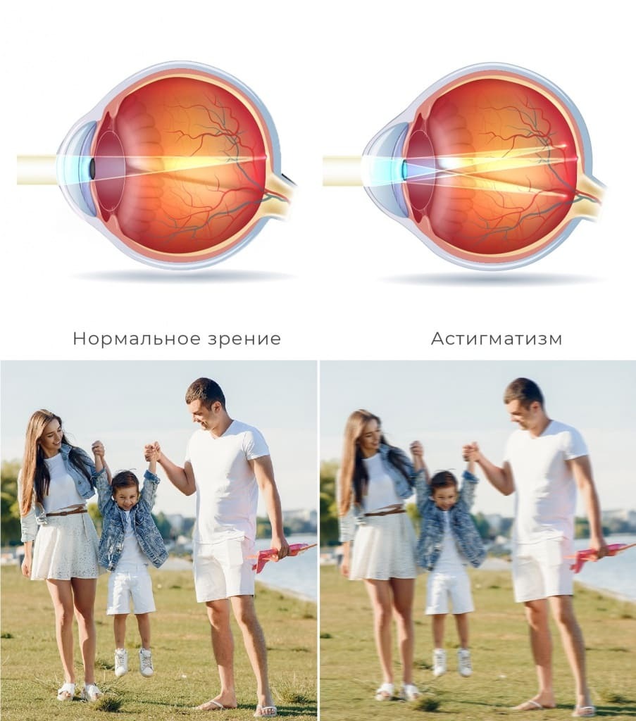 Glasses only for astigmatism correction, without correction for visual acuity - for working on a computer? - Vision, Ophthalmologist, Ophthalmology, Astigmatism, Glasses