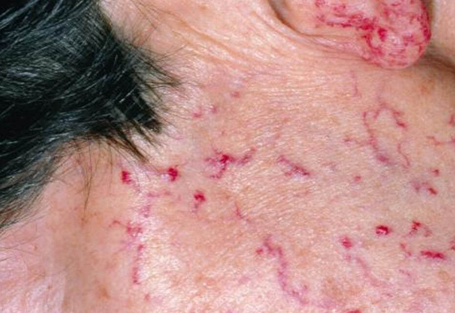 Telangiectasia - Treatment, Health, The medicine, Veins, Disease