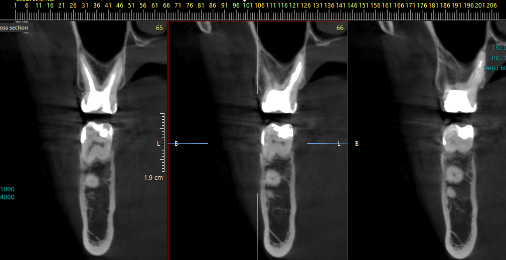 2 cysts of adjacent teeth at the same time - My, Cyst, Teeth, Disease, Disease history, Dentistry, Operation, The medicine, Dentist, Picture with text, Need advice, Question, Doctors, ENT-Doctors, Pain, Paid medicine, Ask Peekaboo, Toothache, Longpost