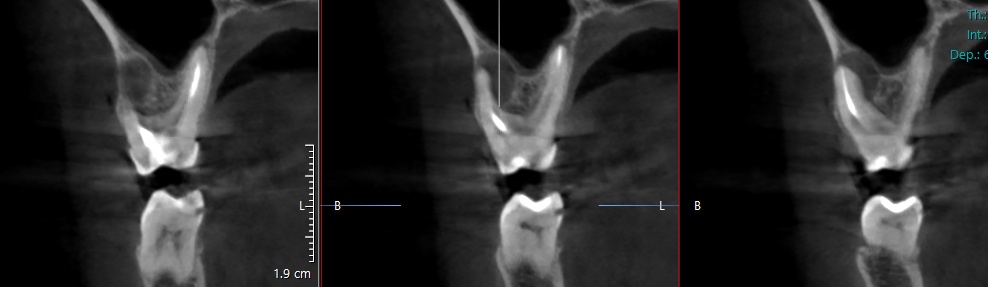 2 cysts of adjacent teeth at the same time - My, Cyst, Teeth, Disease, Disease history, Dentistry, Operation, The medicine, Dentist, Picture with text, Need advice, Question, Doctors, ENT-Doctors, Pain, Paid medicine, Ask Peekaboo, Toothache, Longpost