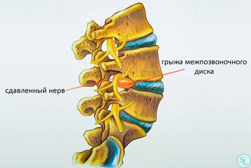 Herniated disc - My, Health, Treatment