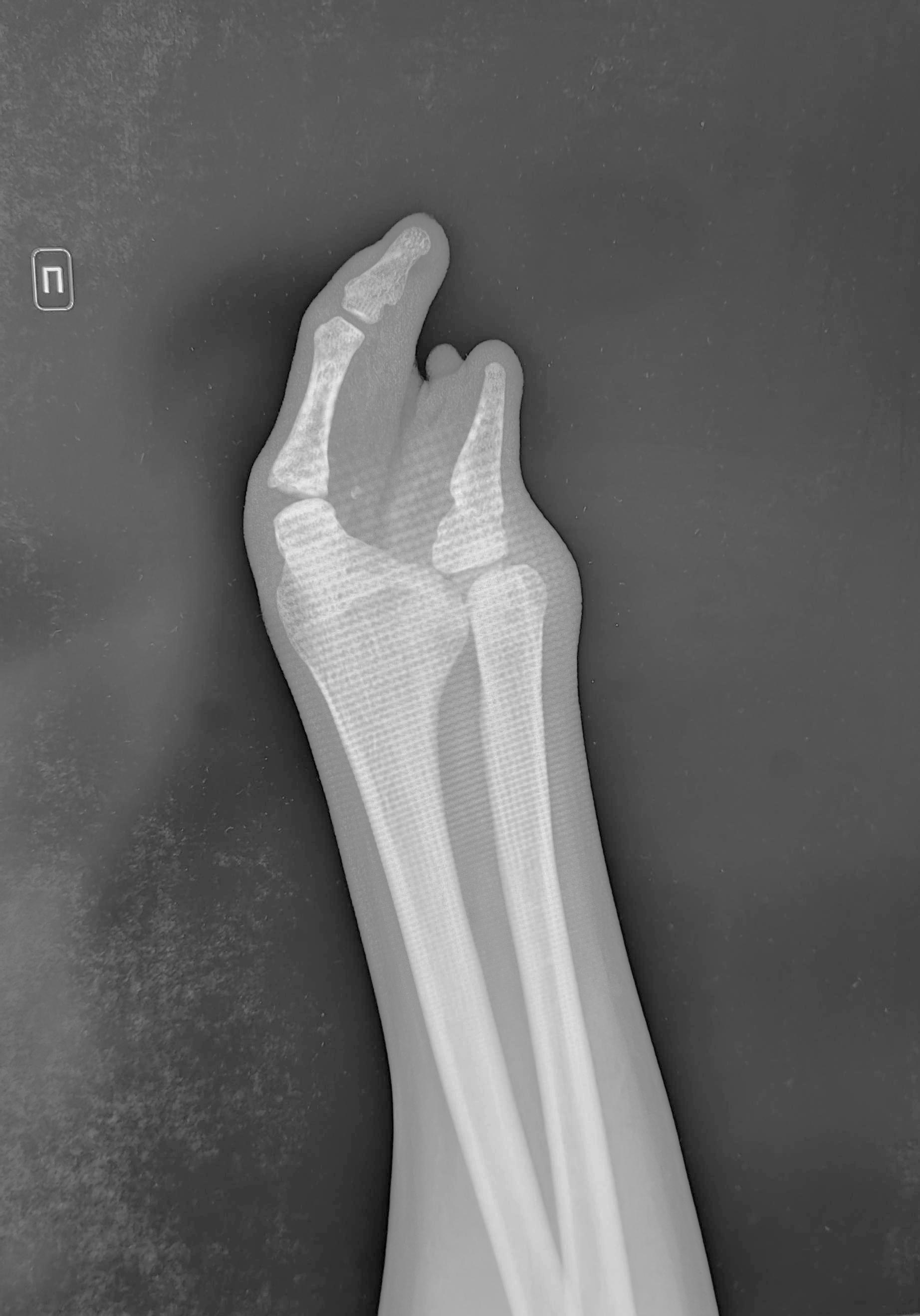 Congenital malformation of the hand - symbrachydactyly - My, The medicine, Bones, Brush, Army, Traumatology, Orthopedics, X-ray, Radiology, Longpost, Conscripts, Conscription